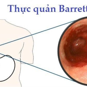 barrett-thuc-quan-la-gi-nguyen-nhan-trieu-chung-chuan-doan-va-dieu-tri