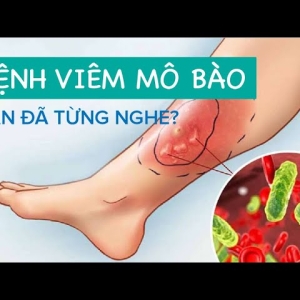 viem-mo-te-bao-la-benh-gi
