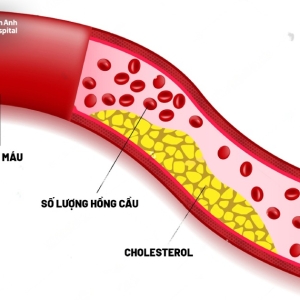 roi-loan-mo-mau-lipid-mau-trieu-chung-nguyen-nhan-cach-phong-ngua