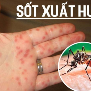 sot-xuat-huyet-dengue-trieu-chung-va-cach-phong-chong-benh