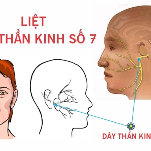 liet-day-than-kinh-so-vii-trieu-chung-nguyen-nhan-dieu-tri