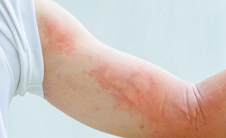 Người mắc giun đũa chó thường ngứa nhiều về đêm, đôi khi vùng da bị gãi xuất hiện dấu hiệu nhiễm trùng.