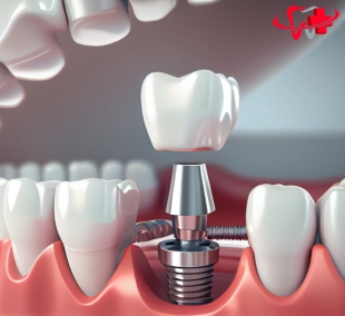 Cấy Ghép Implant